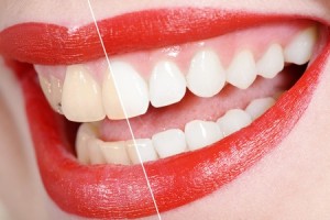 tooth whitening